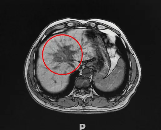 Ventajas e investigación de la crioablación del cáncer de páncreas