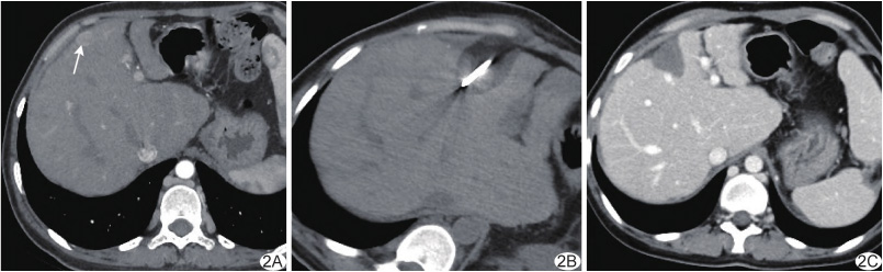 Crioablación del cáncer de hígado