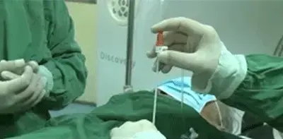 Aplicación de Co-Ablación en Cirugía de Cáncer de Mama