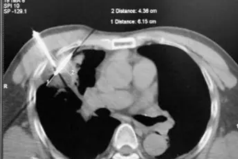 Consenso de Expertos sobre la Práctica Clínica de la Ablación Multimodal por Frío y Calor Percutánea para el Tratamiento del Tumor Maligno Pulmonar