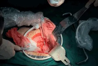 Estudio clínico y experimental de la terapia de ablación combinada con quimioterapia o quimioterapia sola en el tratamiento del cáncer de páncreas en estadio IV
