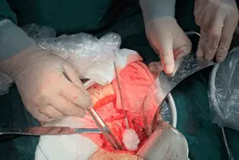 Crioablación más sintilimab y lenvatinib en el colangiocarcinoma intrahepático avanzado o metastásico: un ensayo de fase 2