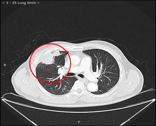 crioterapia para metástasis pulmonares