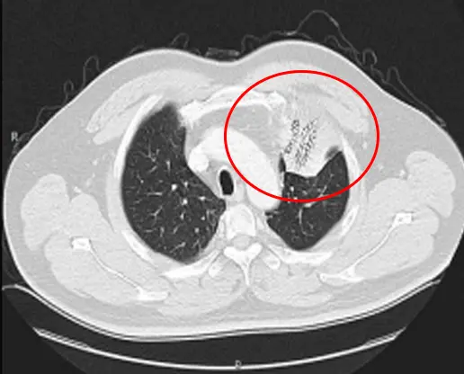criocirugía para el cáncer de pulmón