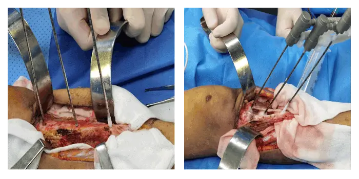 Criocirugía para el cáncer de hueso