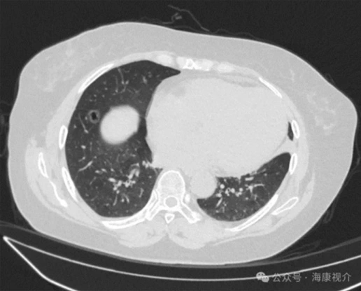 Sistema criocirúrgico para el cáncer de pulmón