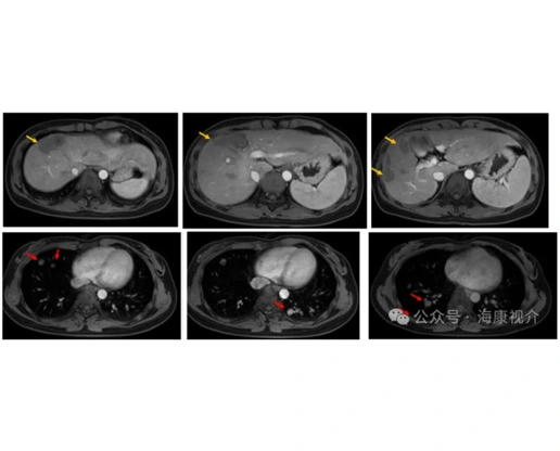 Sistema de criocirugía para metástasis pulmonar de cáncer de hígado